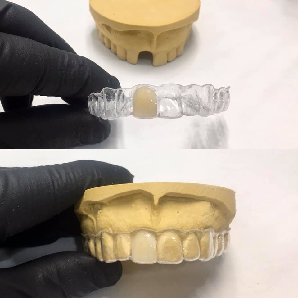 Essix Partial Denture Retainer