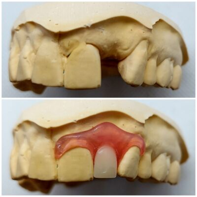 Nesbit Flexible Partial Denture