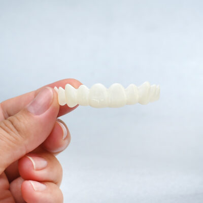 Vida Veneers Custom-Made Snap-On Veneers